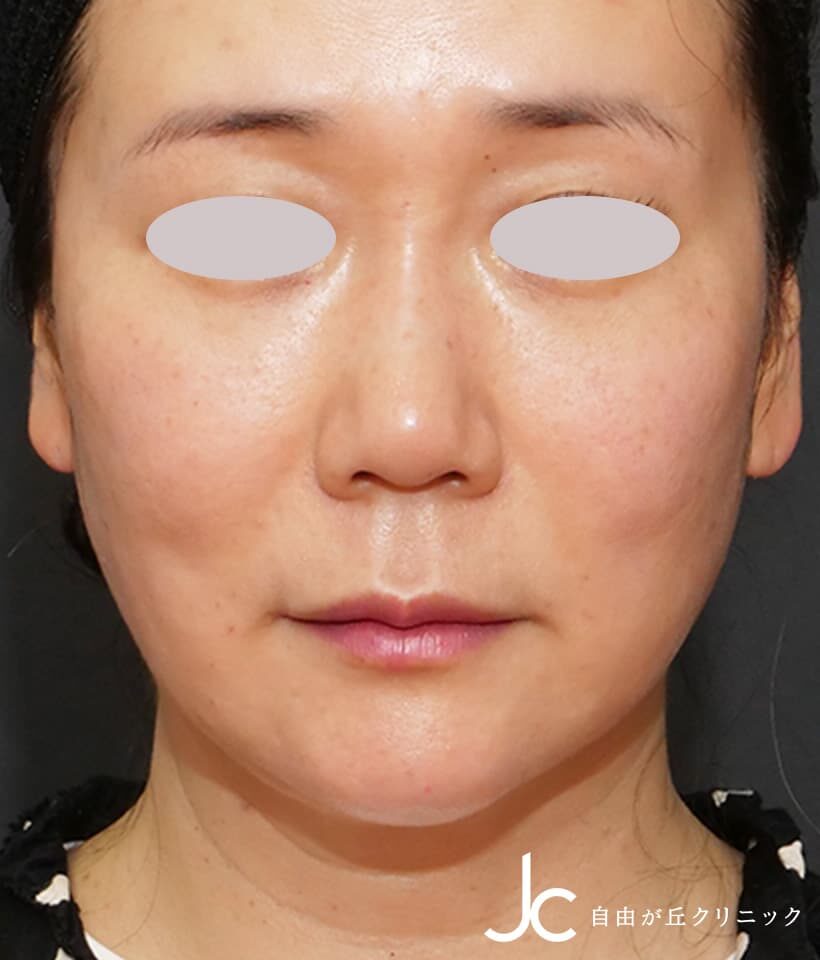 ヒアルロン酸注射AFTER画像