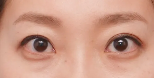 二重切開（全切開法） AFTER画像