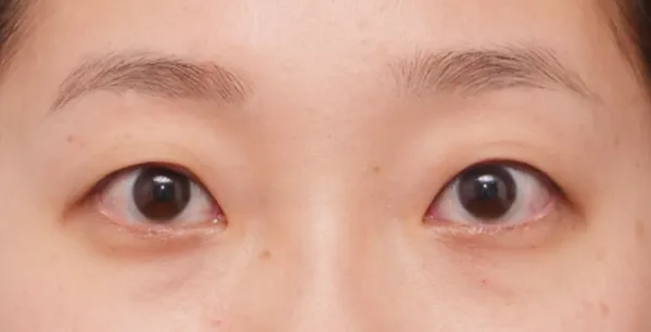 二重切開（全切開法） BEFORE画像