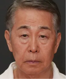 ヒアルロン酸注射<br>ボトックス注射<br>糸リフト BEFORE画像