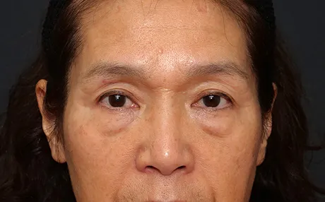上まぶたのたるみ取り（眉毛下皮膚切除） BEFORE画像