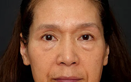 上まぶたのたるみ取り（眉毛下皮膚切除） AFTER画像