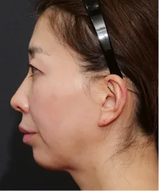 ヒアルロン酸注射<br>ボトックス注射<br>糸リフト BEFORE画像