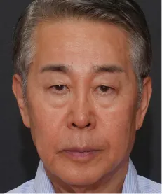 ヒアルロン酸注射<br>ボトックス注射<br>糸リフト AFTER画像