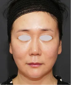 ヒアルロン酸注射<br>ボトックス注射<br>糸リフト AFTER画像