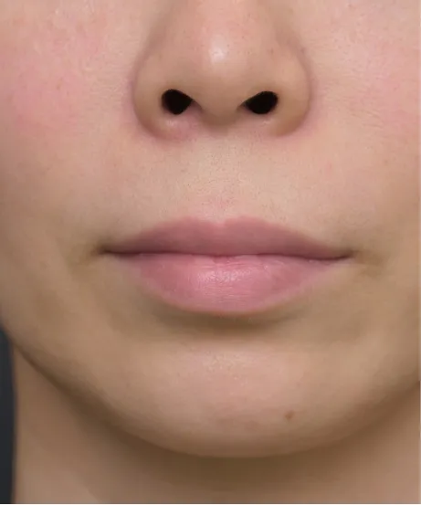 ヒアルロン酸注射 AFTER画像