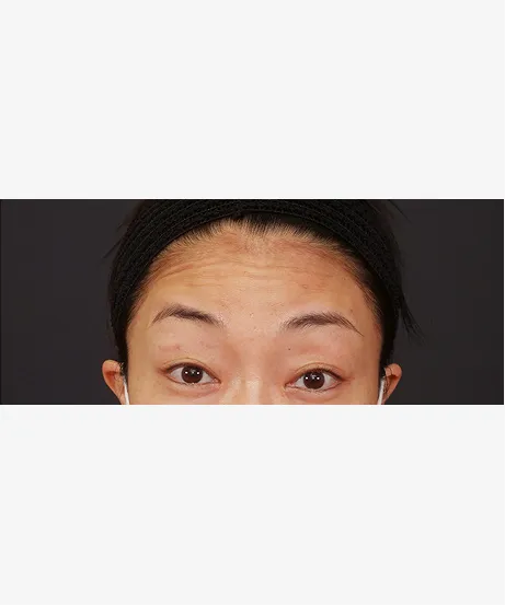 ボトックス注入BEFORE画像