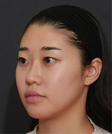 ヒアルロン酸注射 AFTER画像