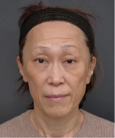 ヒアルロン酸注射<br>ボトックス注射 BEFORE画像