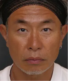 ヒアルロン酸注射<br>ボトックス注射<br>糸リフト BEFORE画像