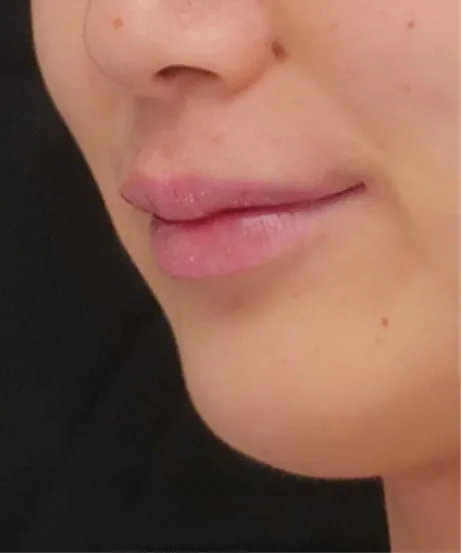 ヒアルロン酸注射 AFTER画像