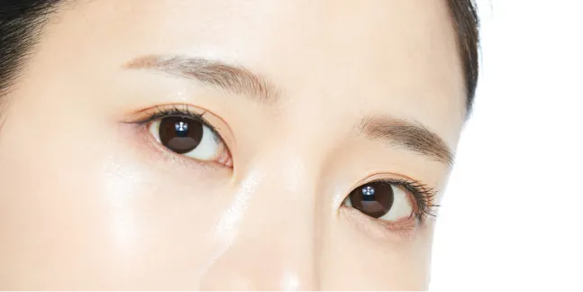 二重まぶた埋没法