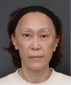 ヒアルロン酸注射<br>ボトックス注射 AFTER画像