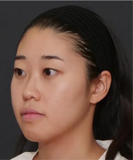 ヒアルロン酸注射 BEFORE画像