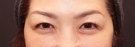 ボトックス注射：目尻（両側）のしわ AFTER画像