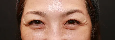 ボトックス注射：目尻（両側）のしわ BEFORE画像