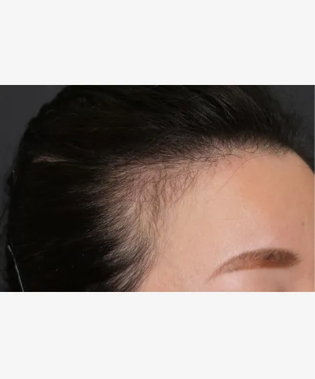 頭皮注射による薄毛治療（高濃度W-PRP療法） BEFORE画像