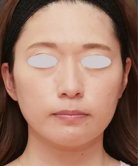 小鼻縮小術 AFTER画像