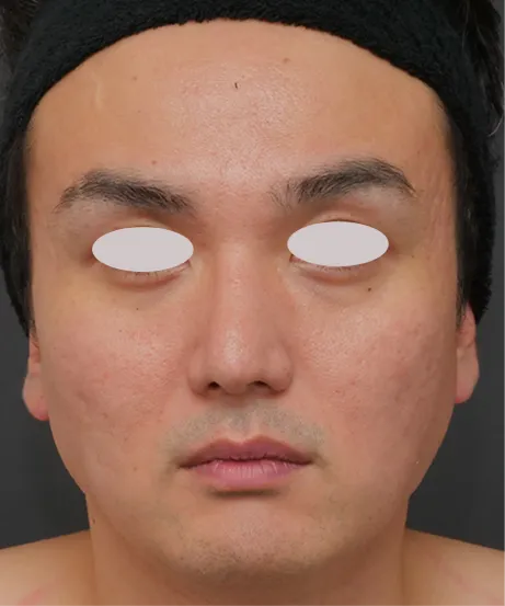 ダーマペン4（肌再生スタンダード） AFTER画像