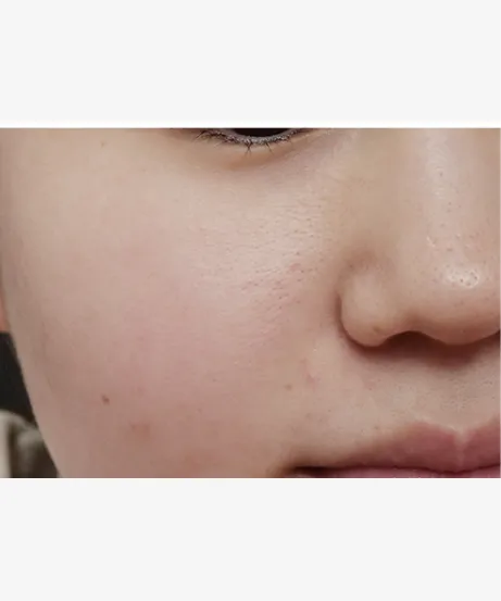 レーザー AFTER画像