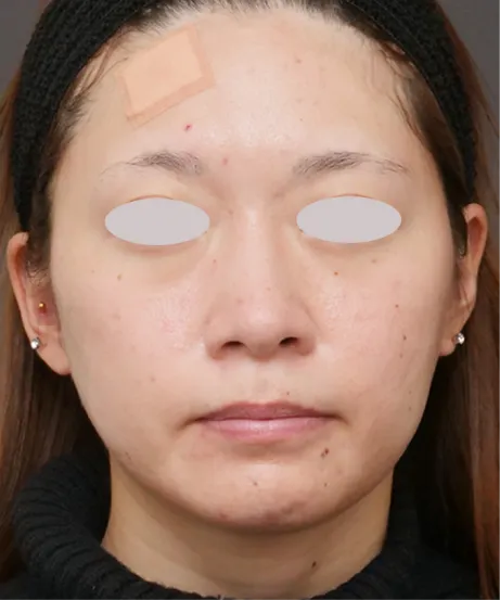 小鼻縮小術 BEFORE画像