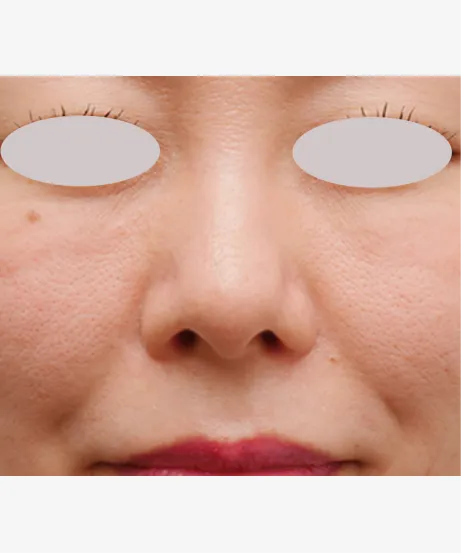 ダーマペン4（肌再生スタンダード） BEFORE画像