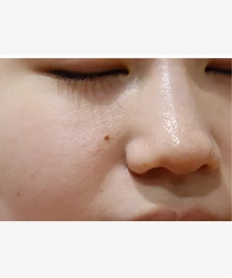 レーザー BEFORE画像