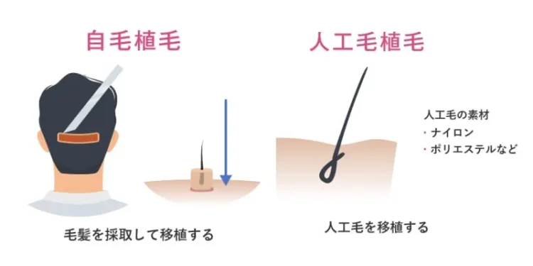 自毛植毛と人工毛植毛の説明画像