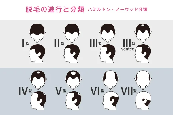 薄毛の進行度度合いについて