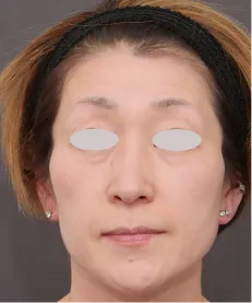 ヒアルロン酸注射<br>ボトックス注射 BEFORE画像