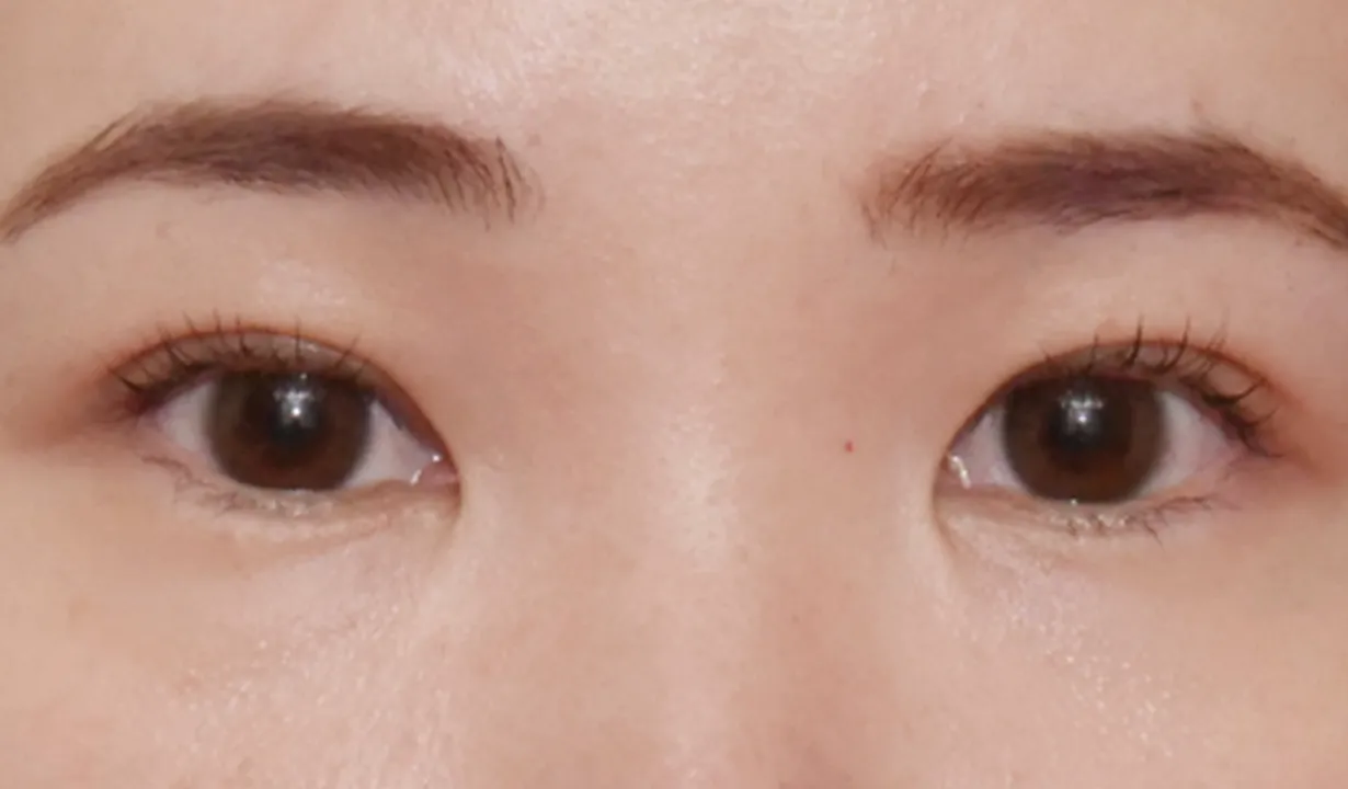 二重埋没（2点法） AFTER画像