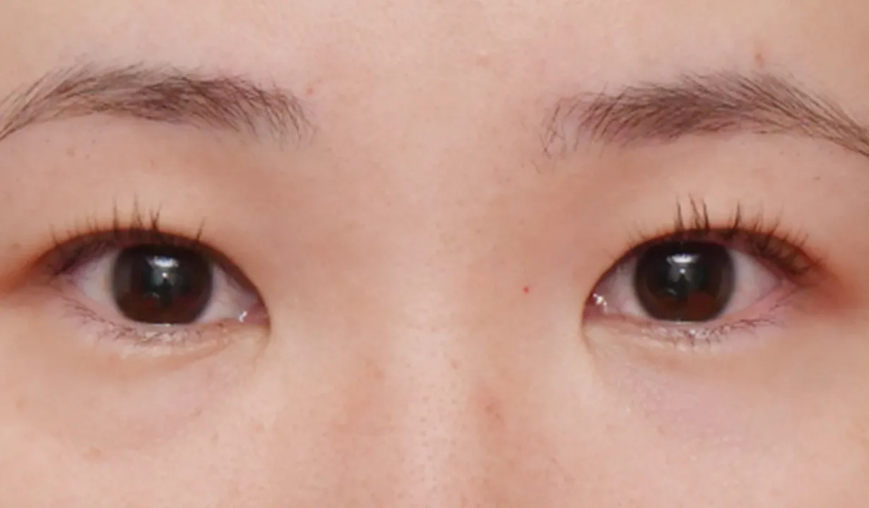 二重埋没（2点法） BEFORE画像