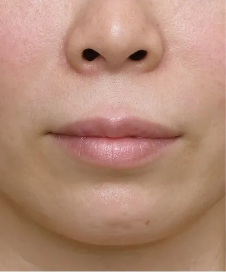 ヒアルロン酸注射 BEFORE画像