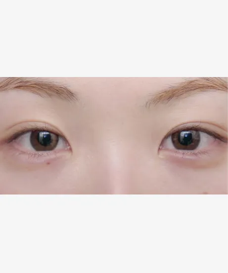 ヒアルロン酸注射 AFTER画像