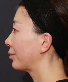 ヒアルロン酸注射<br>ボトックス注射<br>糸リフト AFTER画像