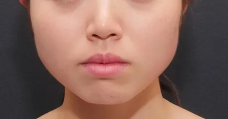 ボトックス注射：エラボトックス AFTER画像