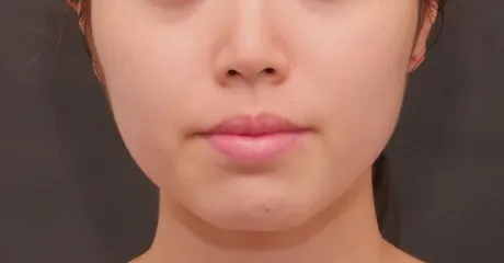 ボトックス注射：エラボトックス BEFORE画像