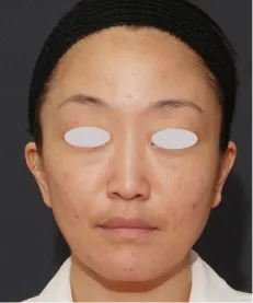 ヒアルロン酸注射<br>ボトックス注射 BEFORE画像