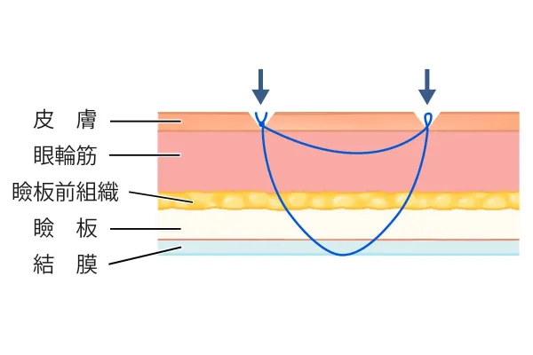 二重まぶた手術の解説イメージ
