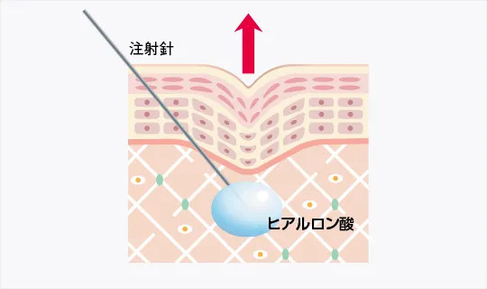 ヒアルロン酸注射の図解