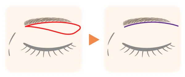 上眼瞼皮膚切除（上眼瞼形成術）のイメージ画像