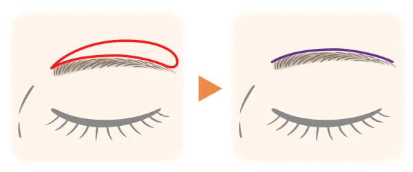 眉毛上皮膚切除のイメージ画像