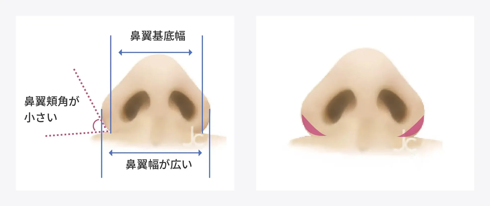 鼻のタイプ別手術法①