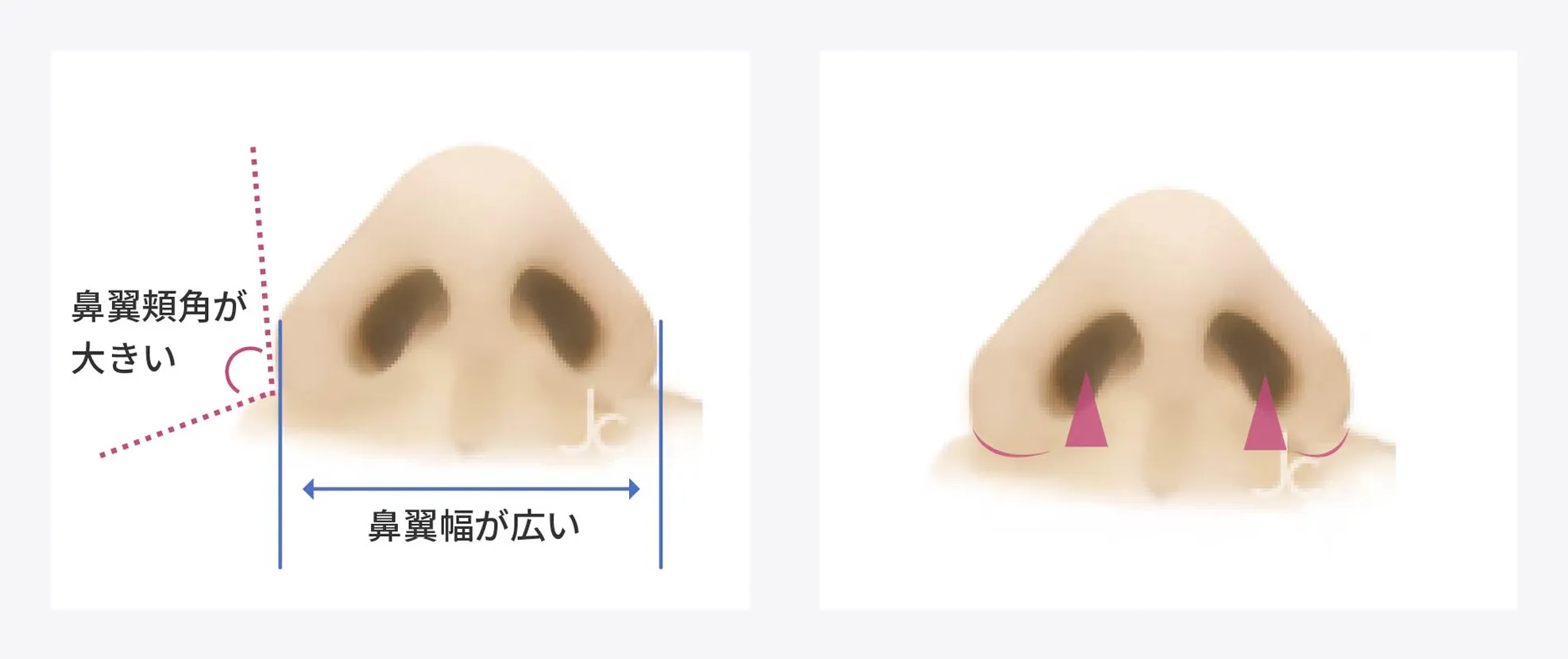 鼻のタイプ別手術法②