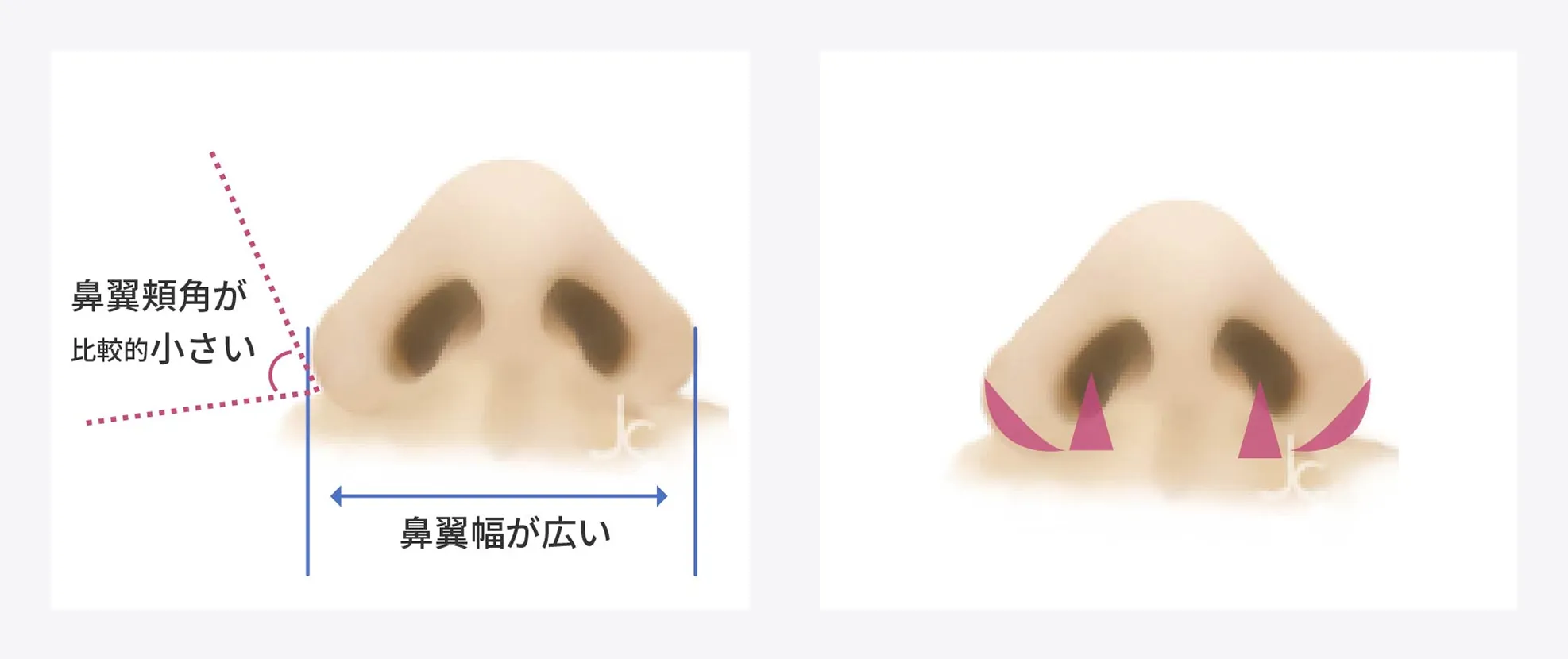 鼻のタイプ別手術法③
