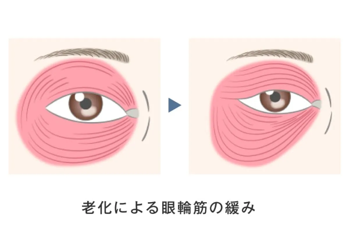 老化による原因