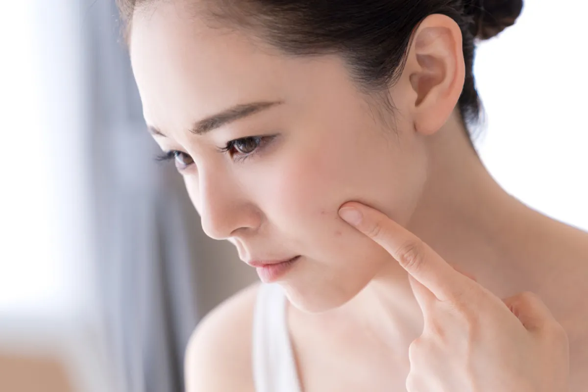 ニキビに悩む女性