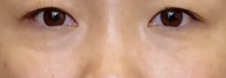 プルリアルデンシフィアシリーズ BEFORE画像