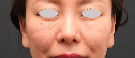 高濃度W-PRP+ダーマペン4 BEFORE画像