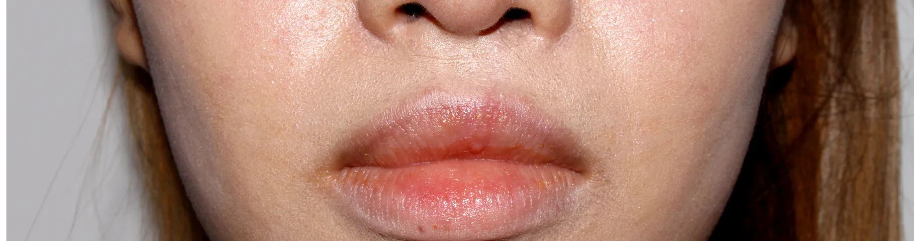 高濃度W-PRP療法 AFTER画像